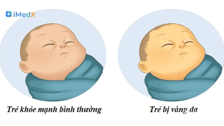 Vàng da sơ sinh — khi nào bình thường, khi nào cần đi khám?