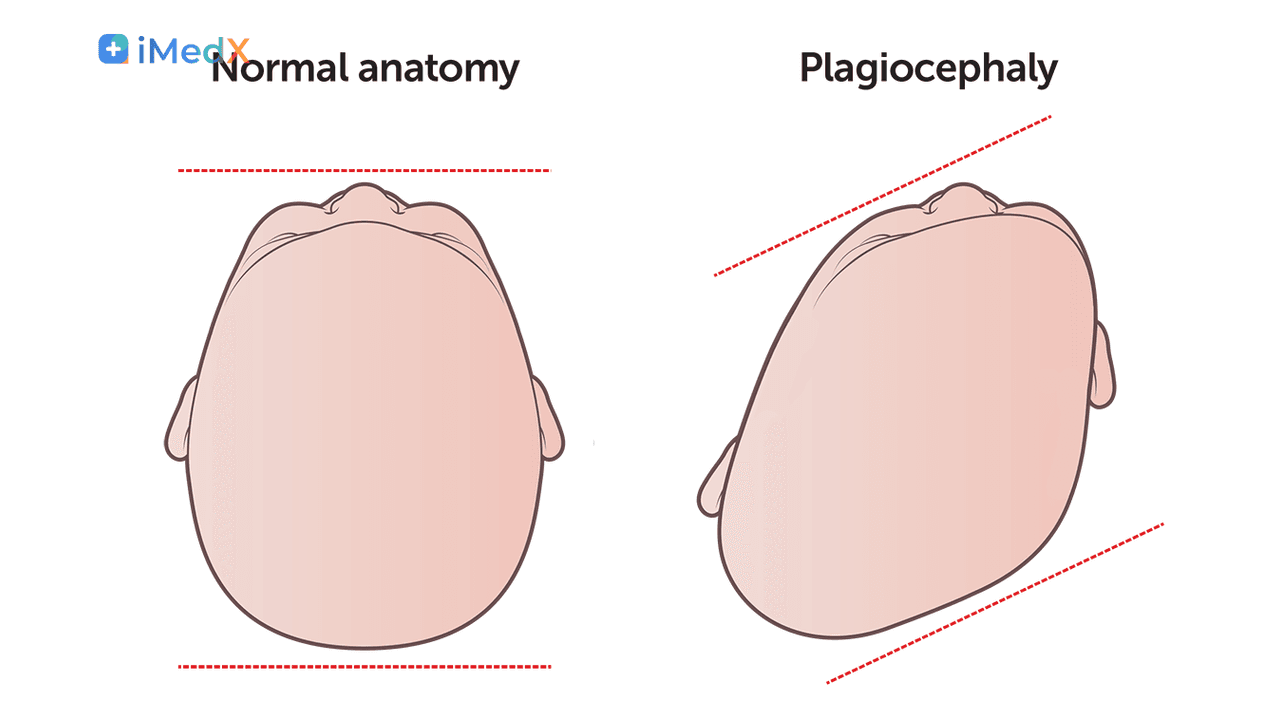 Plagiocephaly và Brachycephaly: Méo đầu ở trẻ sơ sinh
