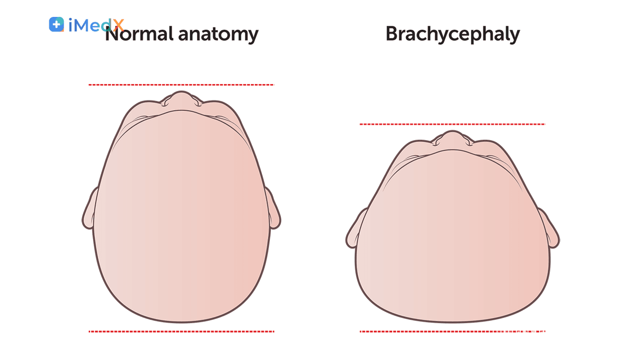 Plagiocephaly và Brachycephaly: Méo đầu ở trẻ sơ sinh