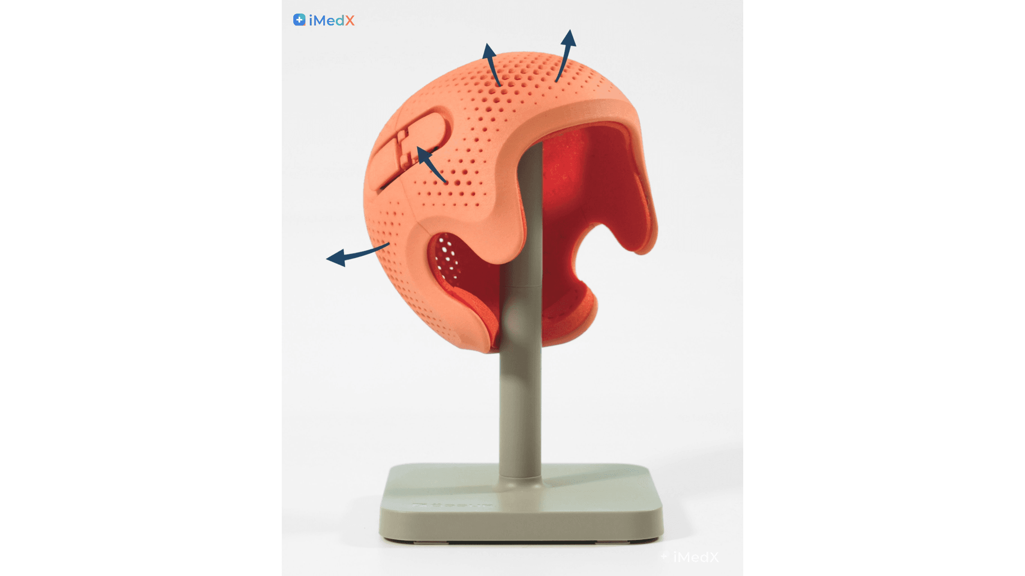 Mũ hỗ trợ định hình 3D khác gì mũ truyền thống?